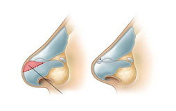 Come si esegue la rinoplastica