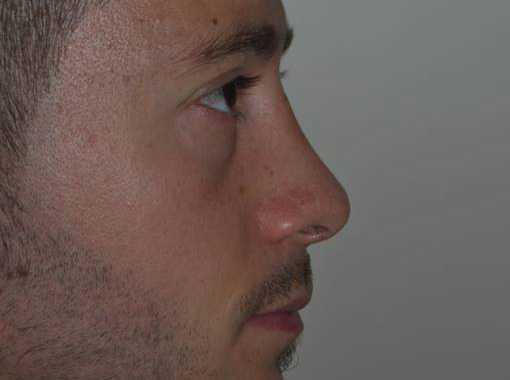 Foto prima e dopo Rinoplastica
