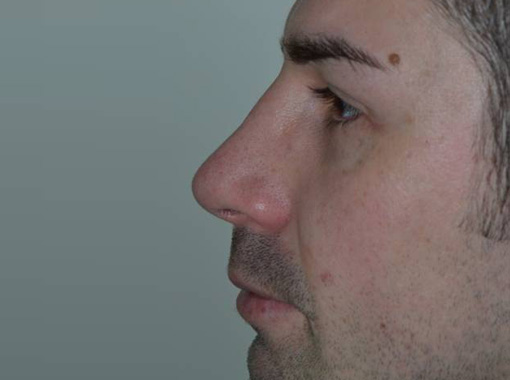Foto prima e dopo Rinoplastica