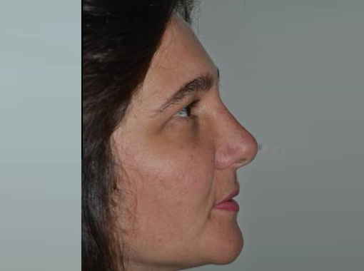 Foto prima e dopo Rinoplastica