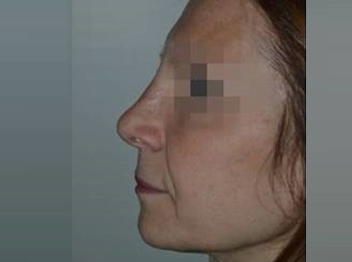Foto prima e dopo Rinoplastica