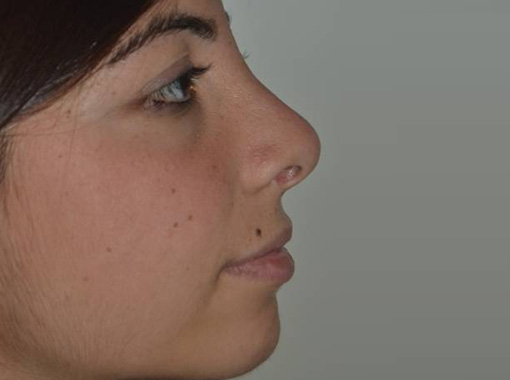 Foto prima e dopo Rinoplastica
