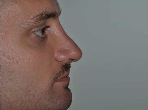Foto prima e dopo Rinoplastica