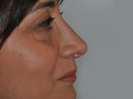 Foto prima e dopo Rinoplastica
