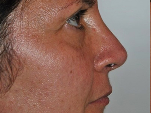 Foto prima e dopo Rinoplastica