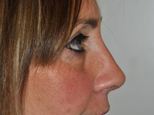 Foto prima e dopo Rinoplastica