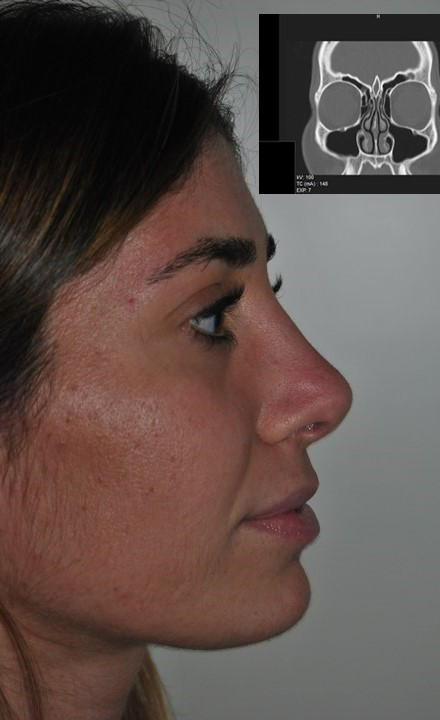 Foto prima e dopo Rinoplastica