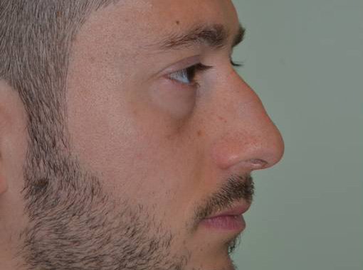 Foto prima e dopo Rinoplastica