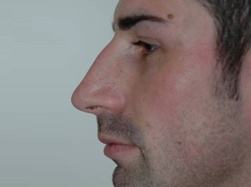 Foto prima e dopo Rinoplastica