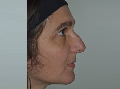 Foto prima e dopo Rinoplastica