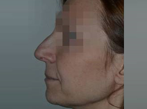 Foto prima e dopo Rinoplastica