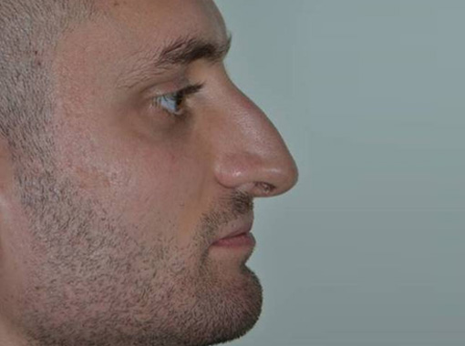Foto prima e dopo Rinoplastica