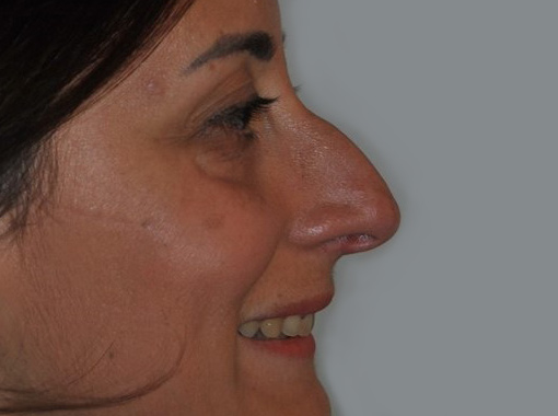 Foto prima e dopo Rinoplastica