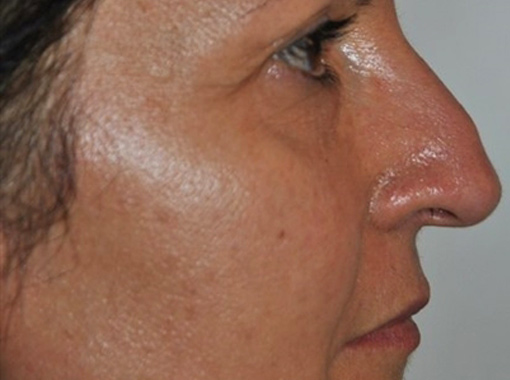 Foto prima e dopo Rinoplastica