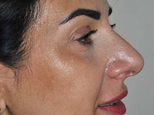 Foto prima e dopo Rinoplastica