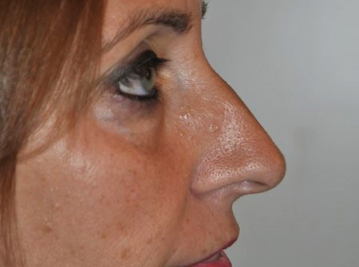 Foto prima e dopo Rinoplastica