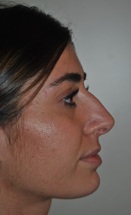Foto prima e dopo Rinoplastica